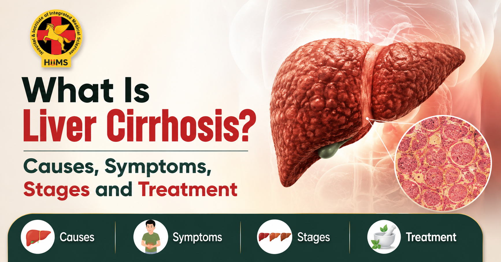 What Is Liver cirrhosis? Causes, Symptoms, Stages and Treatment